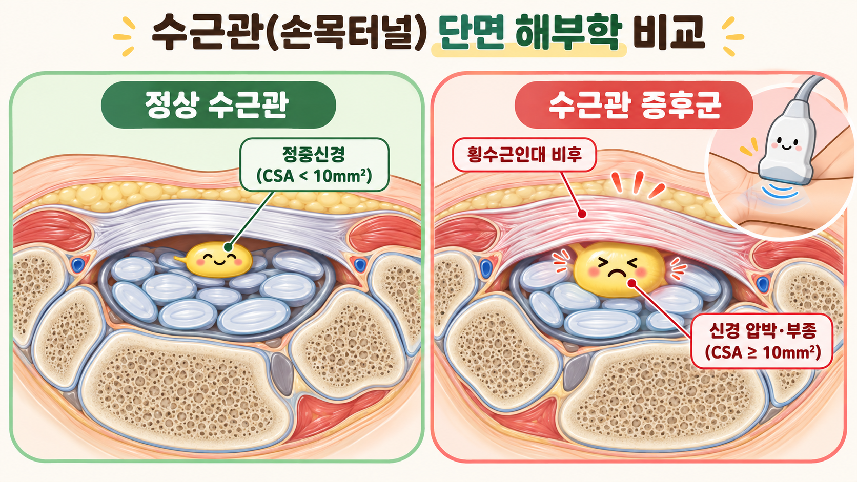수근관 단면 해부학 및 초음파 정중신경 단면적 진단 기준
